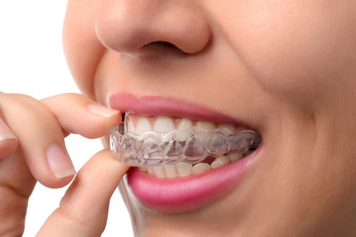 Birmingham, AL Dentist - Invisalign