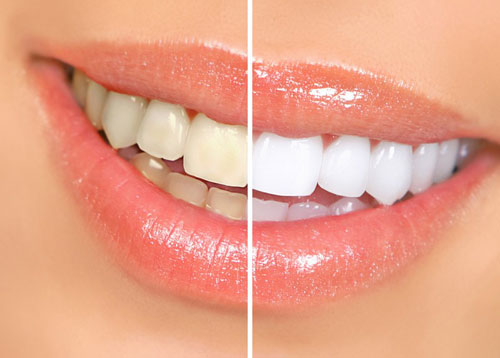 Birmingham, AL Dentist - Whitening